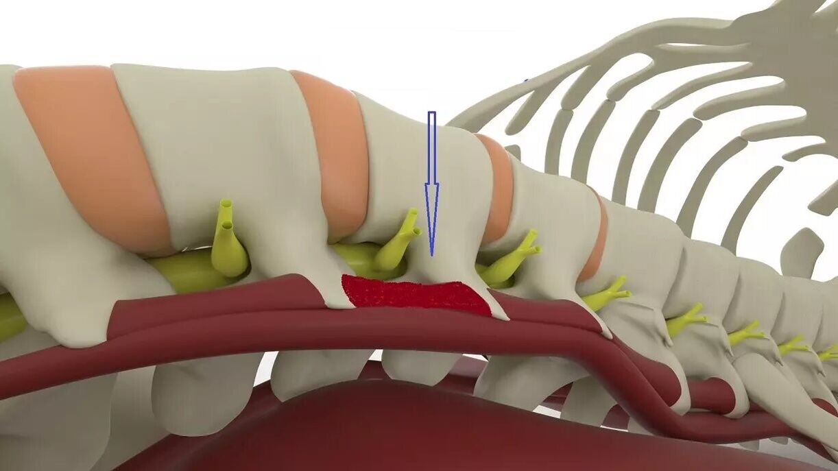skurcz mięśni z osteochondrozą lędźwiową