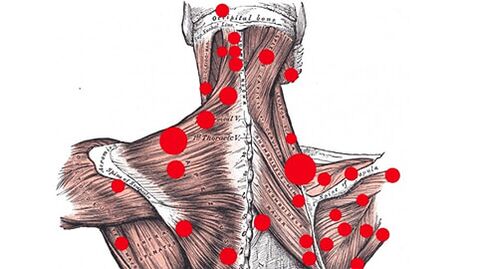 Punkty wyzwalające w mięśniach, które wywołują ból mięśniowo-powięziowy pleców