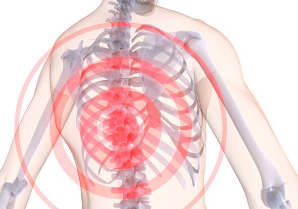 Osteochondrozie klatki piersiowej towarzyszy dorsago - ostry ból ograniczający mięśnie