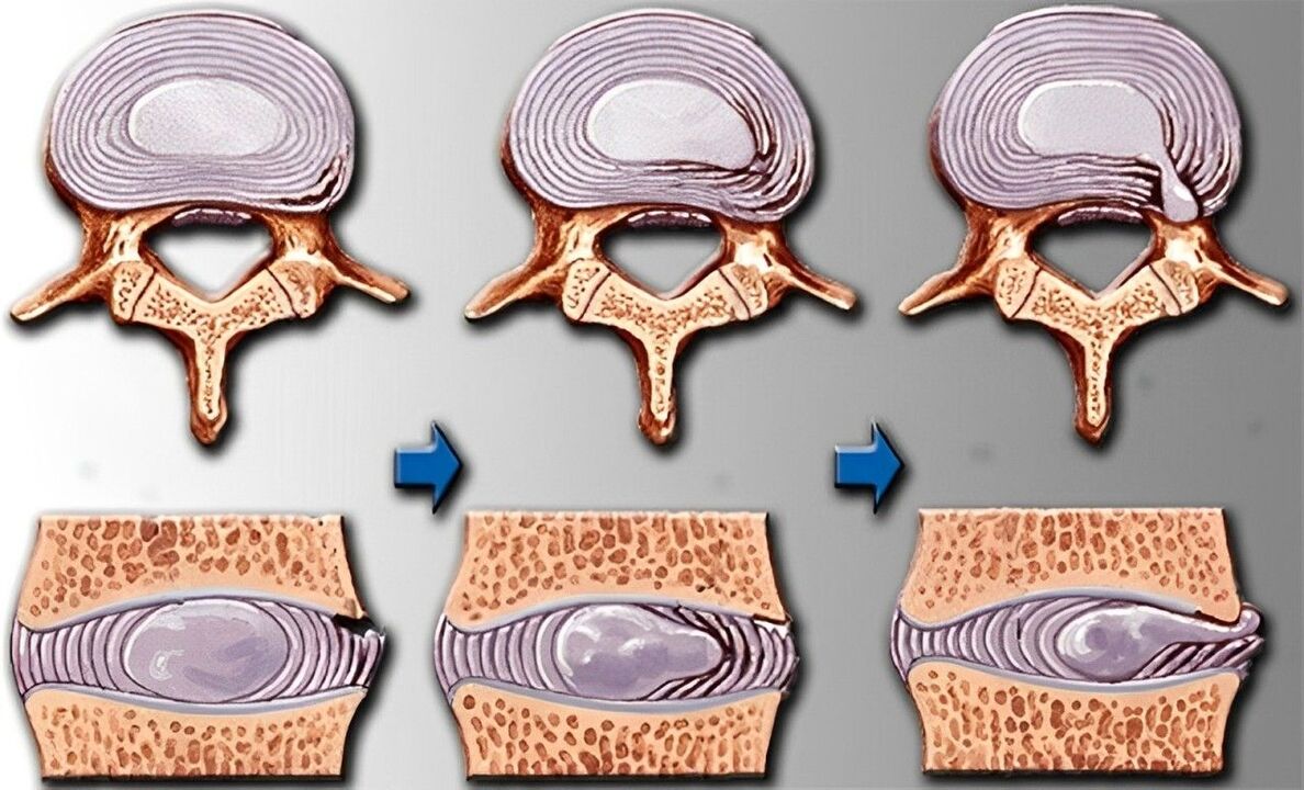 etapy osteochondrozy