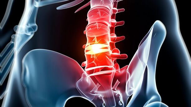 Osteochondroza kręgosłupa lędźwiowego