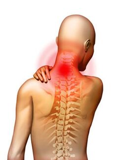 Ból jest głównym objawem osteochondrozy szyjnej